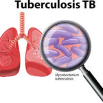 Human Lung with Tuberculosis  illustration